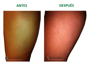 Antes y después 300x225 - Estrías: Antes y Después