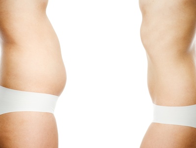 Cirugía esética corporal liposucción abdominoplastia - Cirugía del contorno corporal: Consejos previos a la intervención.