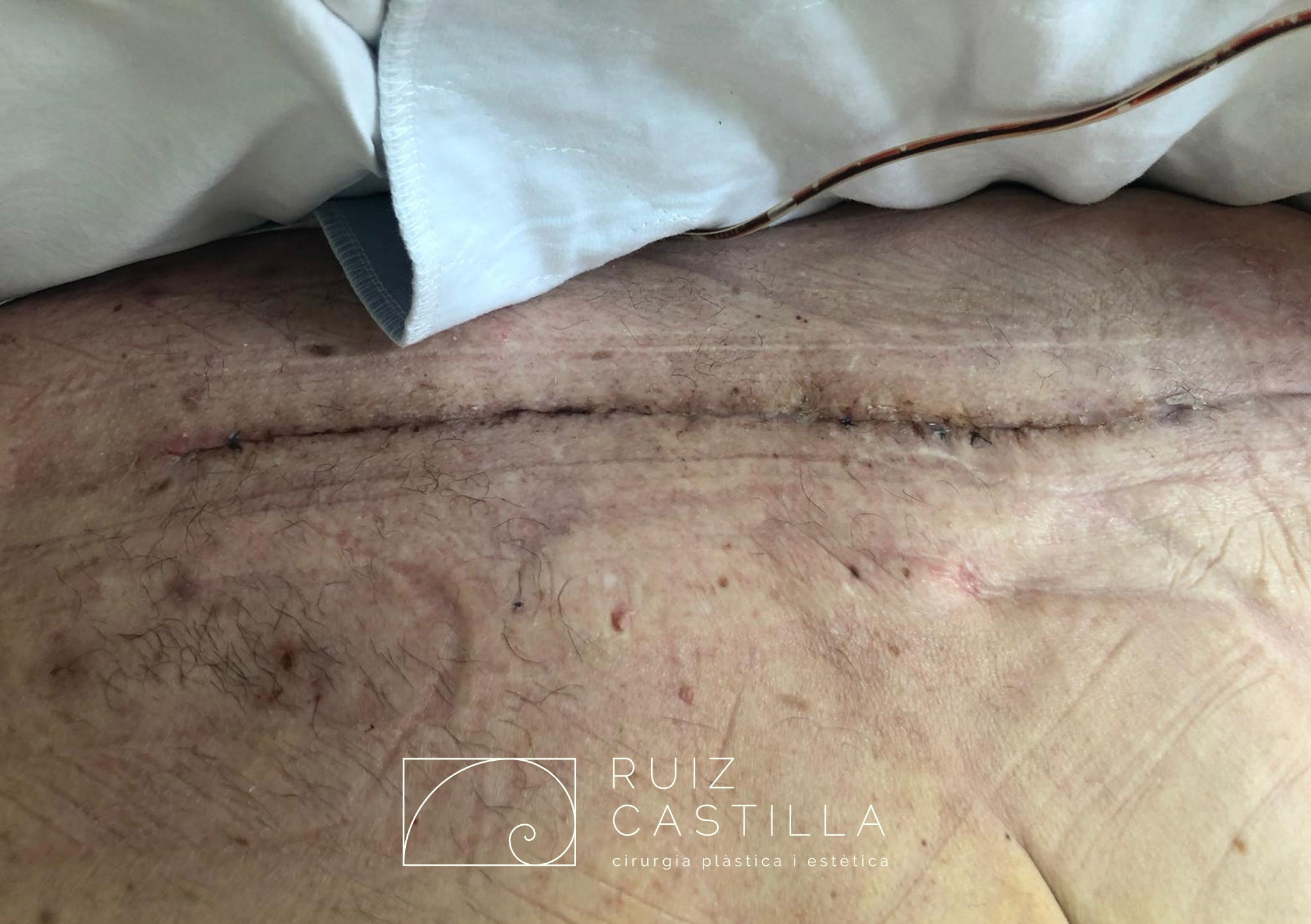 Herida quirúrgica completamente cicatrizada - Manejo multiplano de dehiscencia quirúrgica recidivante