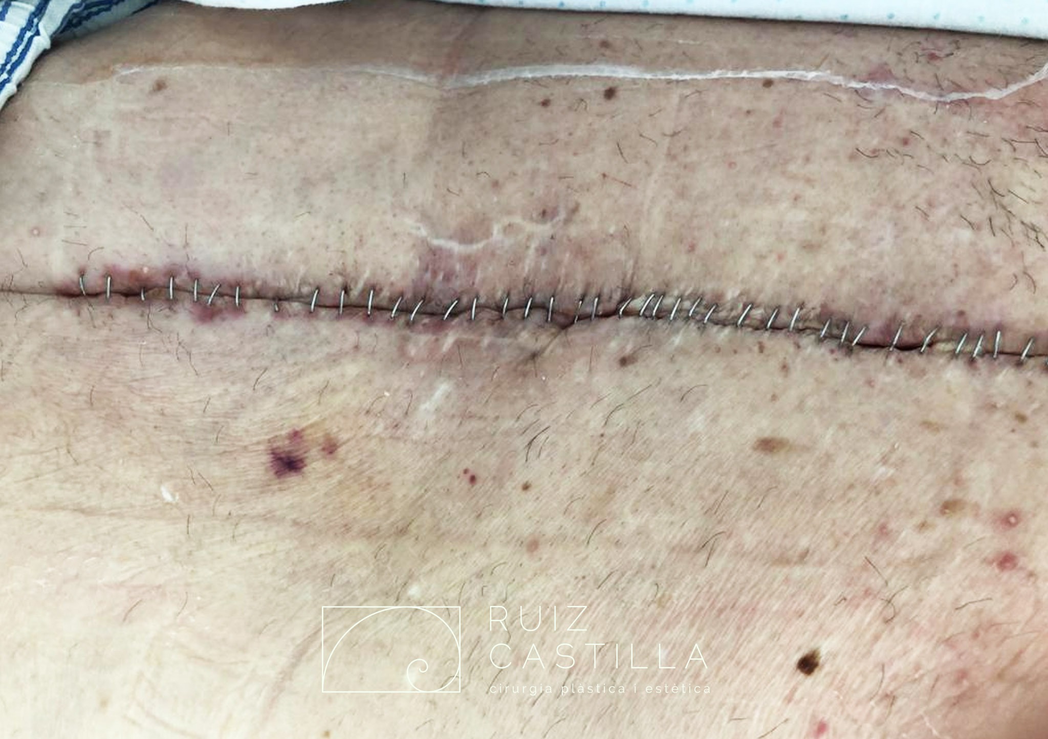 estadio previo externo herida - Manejo multiplano de dehiscencia quirúrgica recidivante