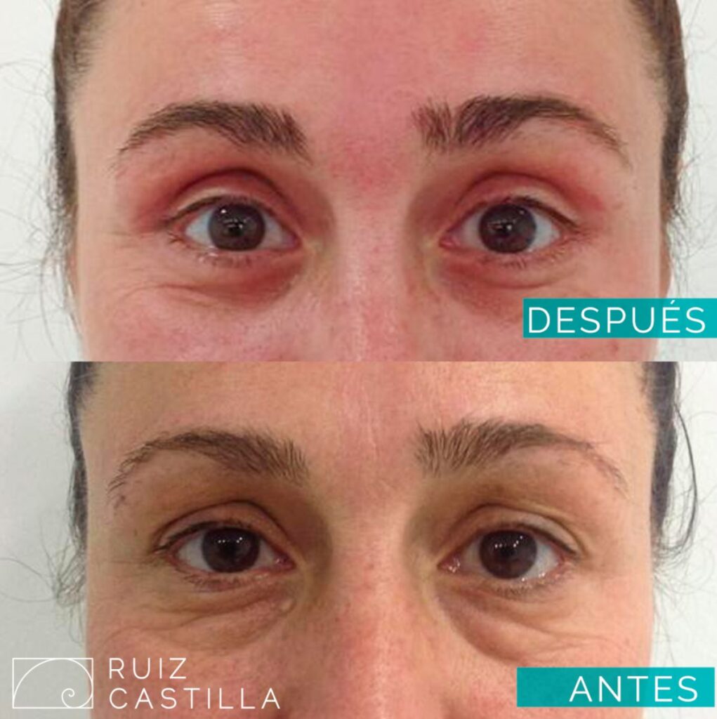 Blefaroplastia 1021x1024 - Blefaroplastia antes y después