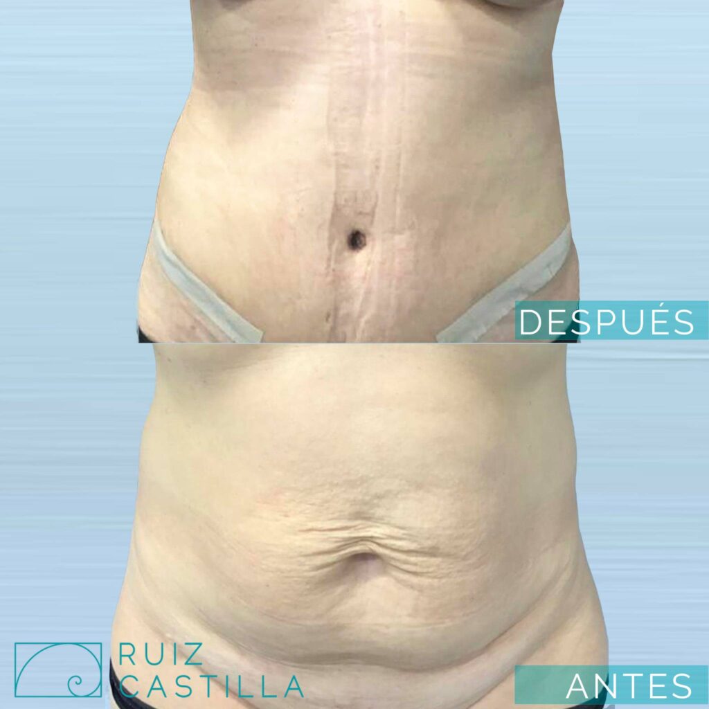 abdominoplastia clasica 1024x1024 - Resultado de una abdominoplastia clásica