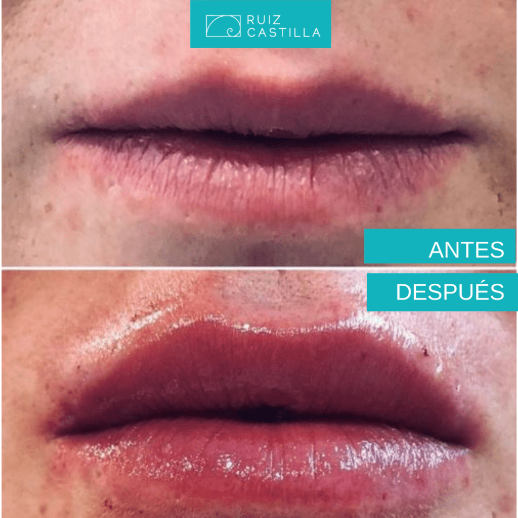 aumento de labios 1 1024x1024 - Antes y después labios tratados con ácido hialurónico