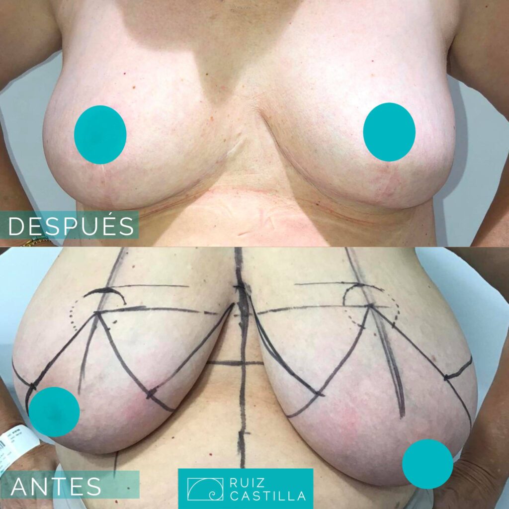 reduccion mamaria 1024x1024 - Reducción de senos antes y después