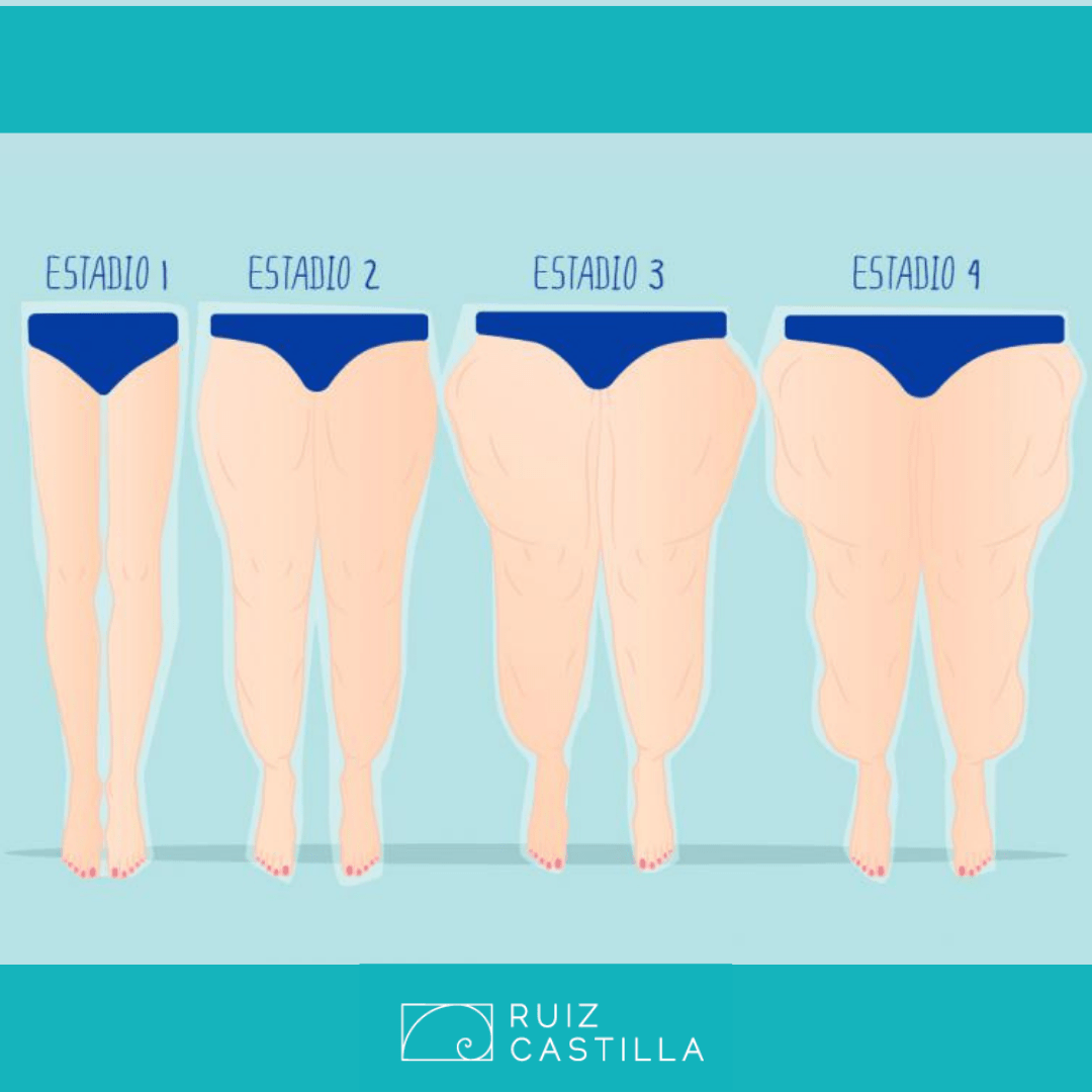 Tratamiento del lipedema y consejos para pacientes