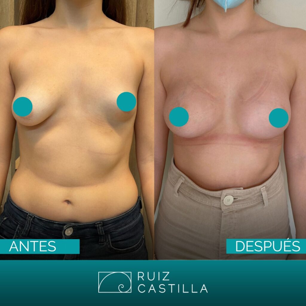 correccion de asimetria mamas tuberosas