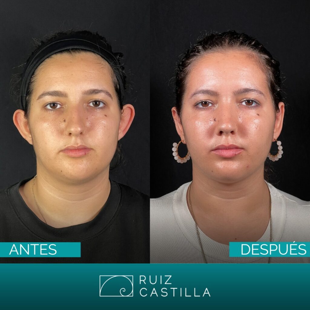 otoplastia antes y despues 1