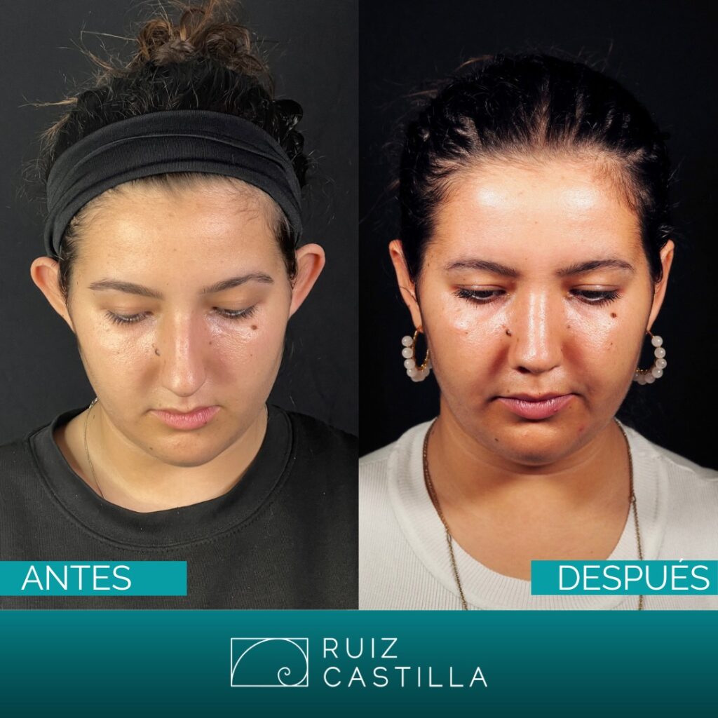 otoplastia antes y despues 2