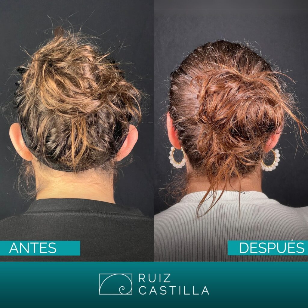 otoplastia antes y despues 3