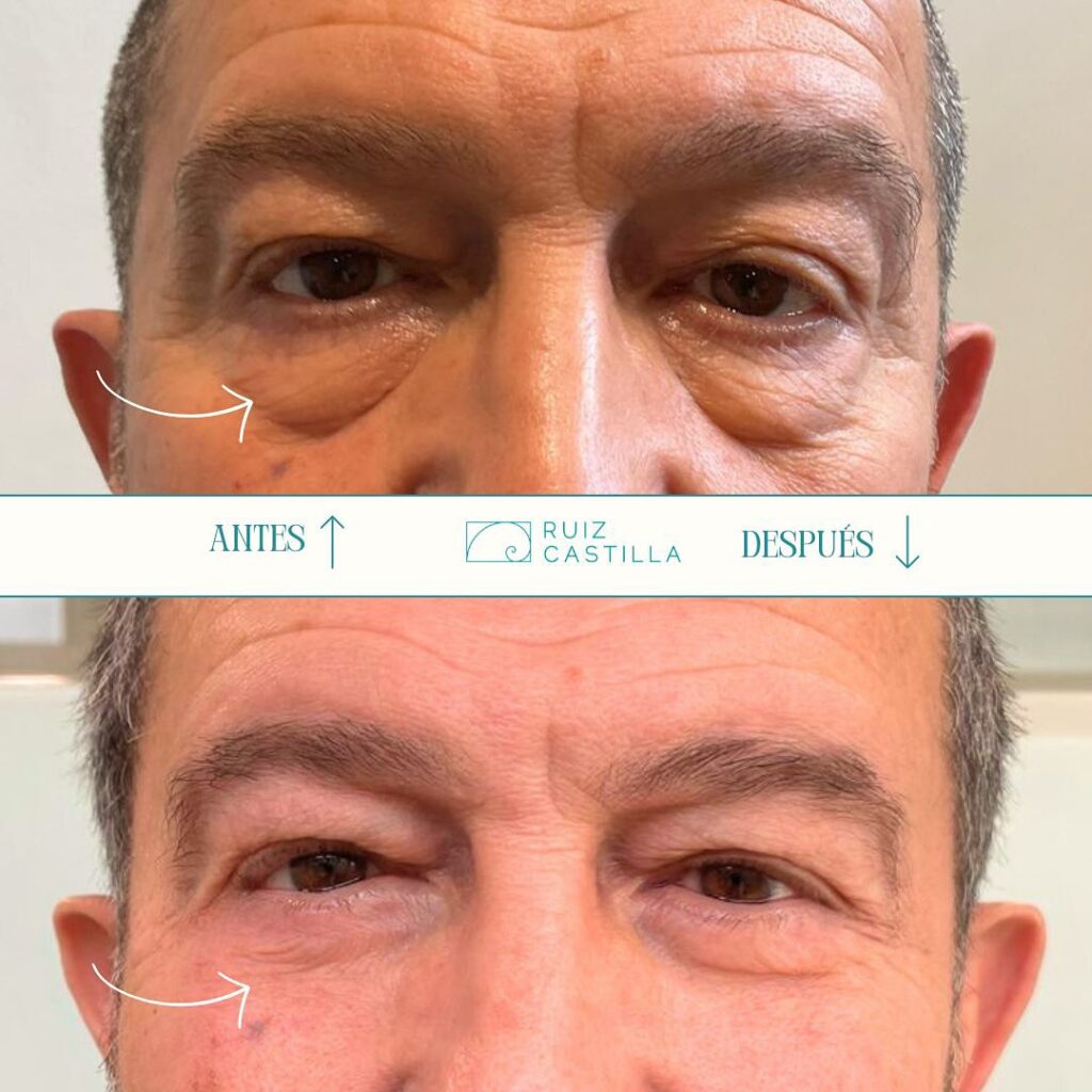 blefaroplastia_en_hombres